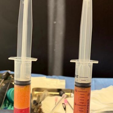 O Nanofat no couro cabeludo é um tratamento de medicina regenerativa que utiliza células-tronco e fatores de crescimento da própria gordura do paciente para combater a queda e estimular o crescimento capilar