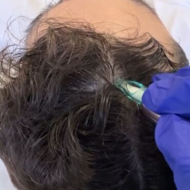 O MMP capilar (Microinfusão de Medicamentos na Pele) é um tratamento médico feito em consultório para queda de cabelo e calvície. Ele usa um aparelho com microagulhas para aplicar remédios e vitaminas direto no couro cabeludo